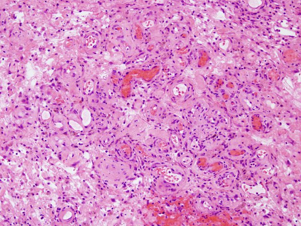 3B7 Radiation Encephalopathy (Case 3) H&E 4