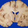 4A1 Radiation Encephalopathy (Case 4) gross 2