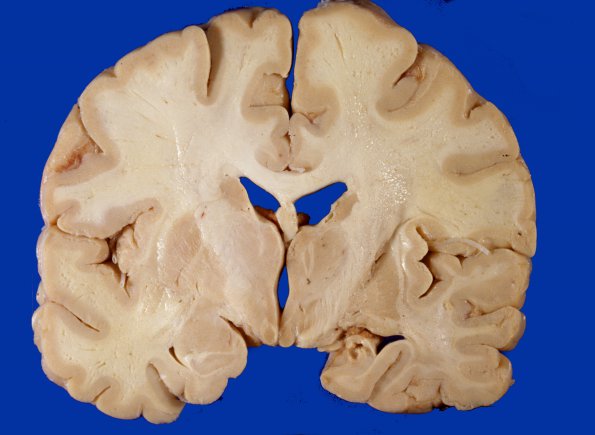 4A1 Radiation Encephalopathy (Case 4) gross 2