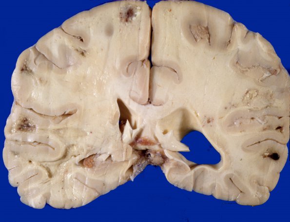 4A2 Radiation Injury, Delayed (Case 4) gross