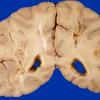 4A3 Radiation Encephalopathy (Case 4) gross 3