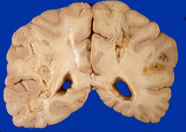 4A3 Radiation Encephalopathy (Case 4) gross 3