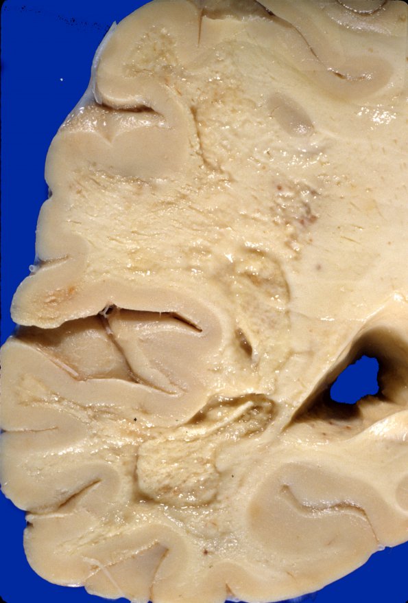 4A4 Radiation Encephalopathy (Case 4) gross 1