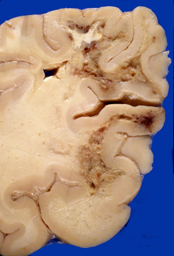 4A5 Radiation Encephalopathy (Case 4) gross 4