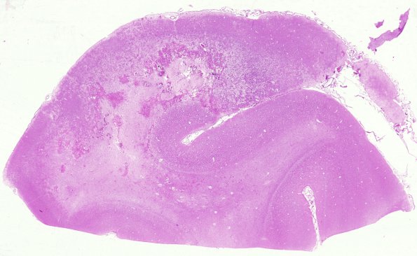 4B1 Radiation Encephalopathy (Case 4) H&E whole mount