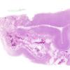 4B2 Radiation Encephalopathy (Case 4) H&E WM