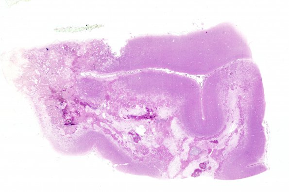 4B2 Radiation Encephalopathy (Case 4) H&E WM