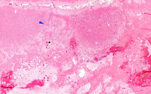 4B3 Radiation Encephalopathy (Case 4) Section I H&E 2X copy