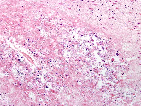 4B5 Radiation Encephalopathy (Case 4) H&E1