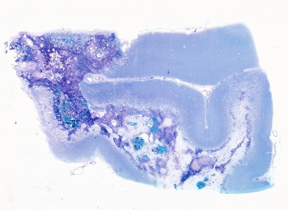 4C1 Radiation Encephalopathy (Case 4) LFB-PAS 3