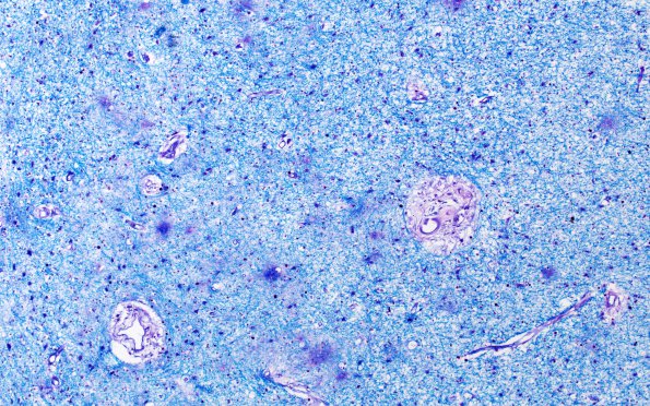 4C4 Radiation Encephalopathy (Case 4) Section I H&E 10X