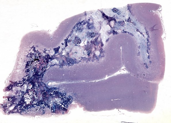 4E1 Radiation Encephalopathy (Case 4) PTAH 4