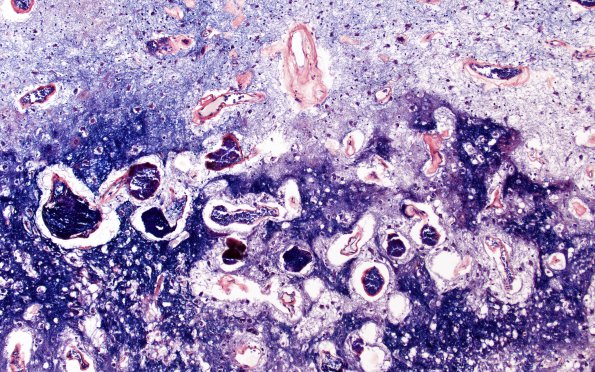 4E2 Radiation Encephalopathy (Case 4) Section O PTAH 10X