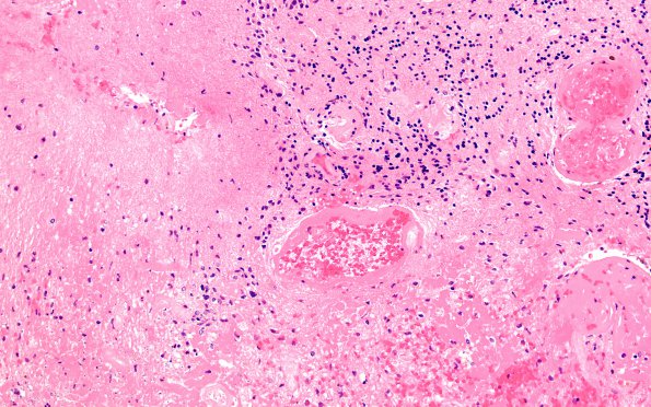 5A2 Radiation effect necrosis (Case 5) H&E 3