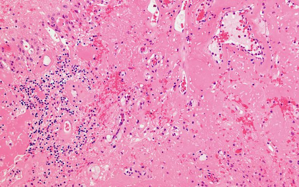 5A3 Radiation effect necrosis (Case 5) H&E 7