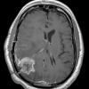 6A1 Radiation necrosis (Case 6) MRI 2 - Copy