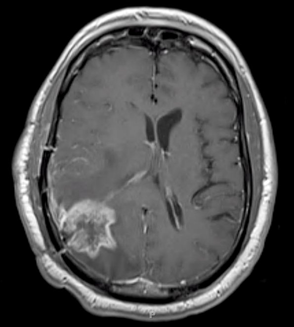 6A1 Radiation necrosis (Case 6) MRI 2 - Copy