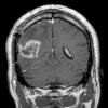 6A2 Radiation necrosis (Case 6) MRI 1 - Copy