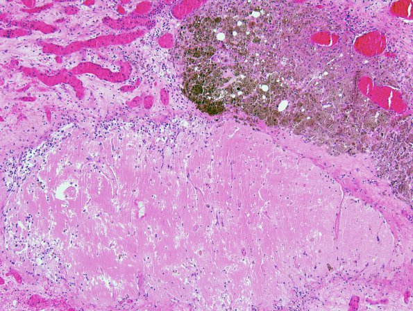 6B2 Radiation necrosis (Case 6) 3