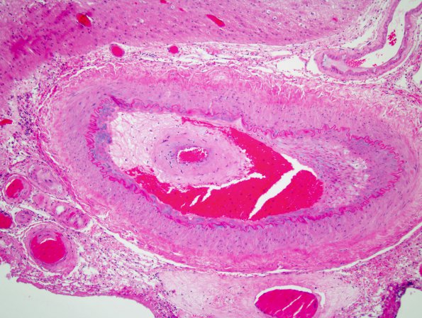 6B3 Radiation necrosis (Case 6) 1