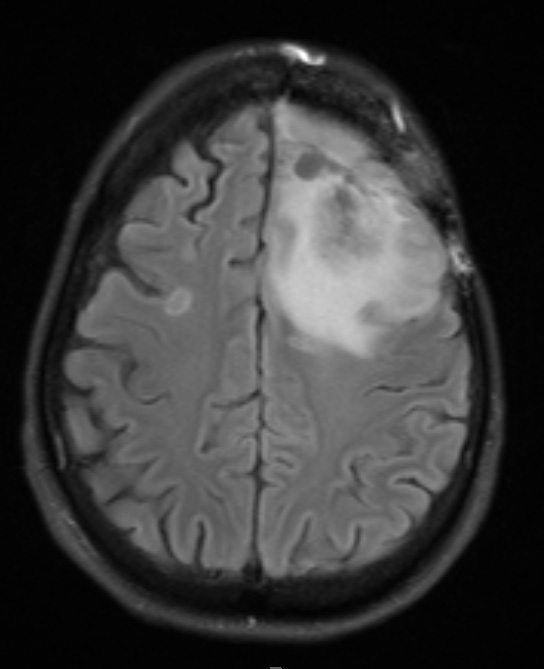 7A1 Radiation Necrosis (Case 7) TRA TIRM 2 - Copy