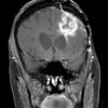 7A2 Radiation Necrosis (Case 7) T1 W 1 - Copy