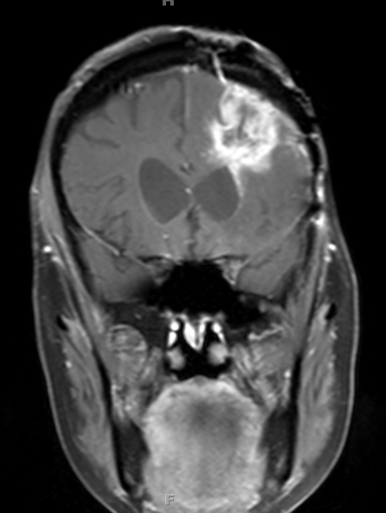 7A2 Radiation Necrosis (Case 7) T1 W 1 - Copy