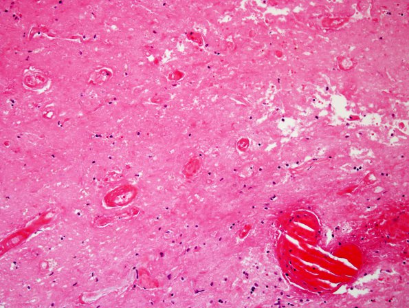 7B1 Radiation-induced necrosis (Case 7) H&E 1