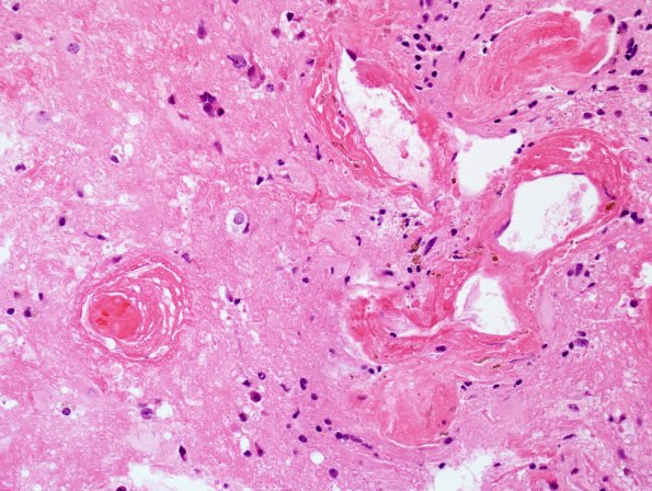 7B2 Radiation-induced necrosis (Case 7) H&E 3