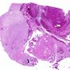 8A1 Radiation Encephalopathy (Case 8) whole mount H&E 1