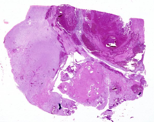 8A1 Radiation Encephalopathy (Case 8) whole mount H&E 1