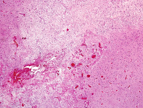 8A2 Radiation Encephalopathy (Case 8) H&E 4