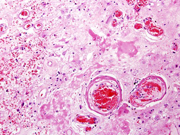 8A3 Radiation Encephalopathy (Case 8) H&E 2