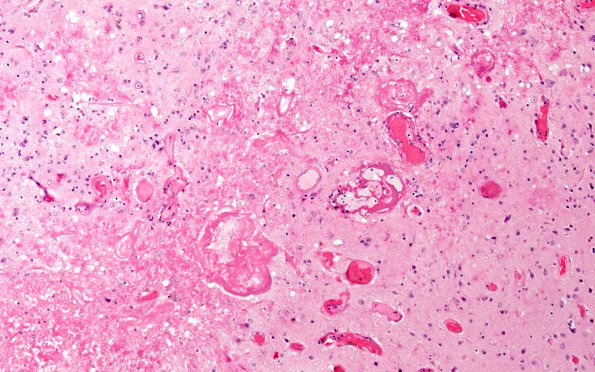 8A4 Radiation Leukoencephalopathy (Case 8) H&E 3