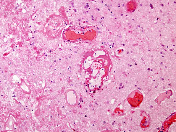 8A5 Radiation Leukoencephalopathy (Case 8) H&E 1 20X 2