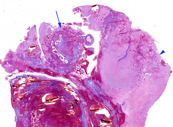 8B1 Radiation Encephalopathy (Case 8) whole mount Trichrome 1 copy