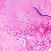 8B2 Radiation Leukoencephalopathy (Case 8) Trichrome 2X