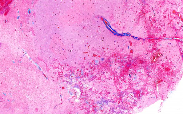 8B2 Radiation Leukoencephalopathy (Case 8) Trichrome 2X