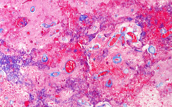 8B3 Radiation Leukoencephalopathy (Case 8) Trichrome 1