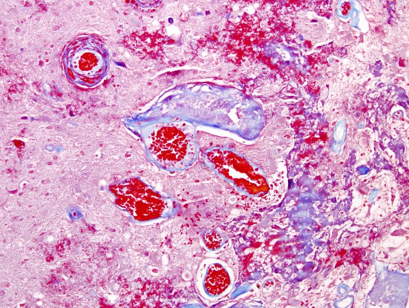 8B4 Radiation Encephalopathy (Case 8) Trichrome 1