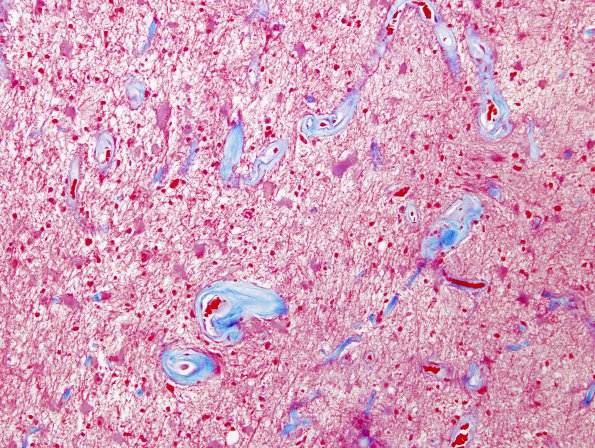 8B5 Radiation Encephalopathy (Case 8) Trichrome 2