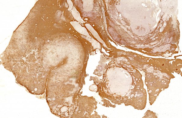 8C1 Radiation Encephalopathy (Case 8) whole mount GFAP