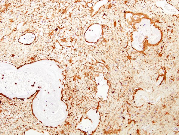 8C2 Radiation Encephalopathy (Case 8) whole mount GFAP 1