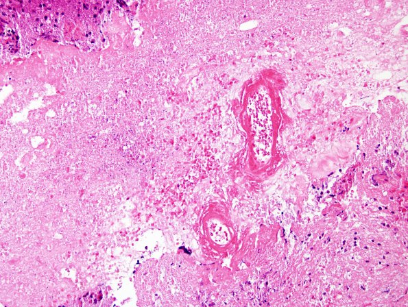 9A2 Radiation Necrosis (Case 9) H&E 1