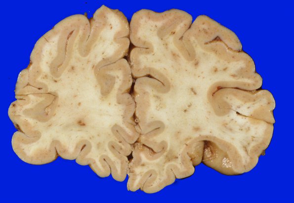 10A1 Infarcts, embolic, fat (Case 10) 9