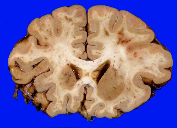 10A2 Infarcts, embolic, fat (Case 10) 4