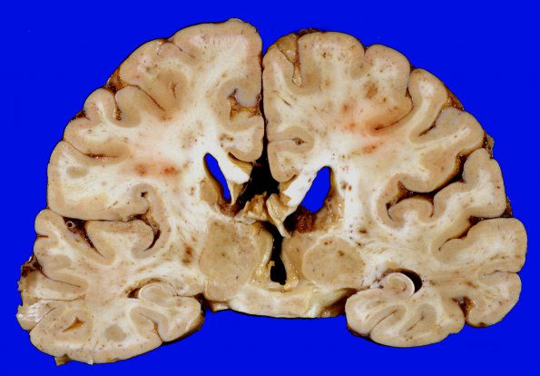 10A3 Infarcts, embolic, fat (Case 10) 7