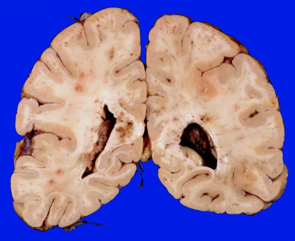 10A4 Infarcts, embolic, fat (Case 10) 8