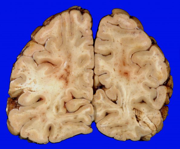 10A5 Infarcts, embolic, fat (Case 10) 6