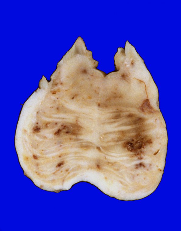 10A6 Infarcts, embolic, fat (Case 10) 2